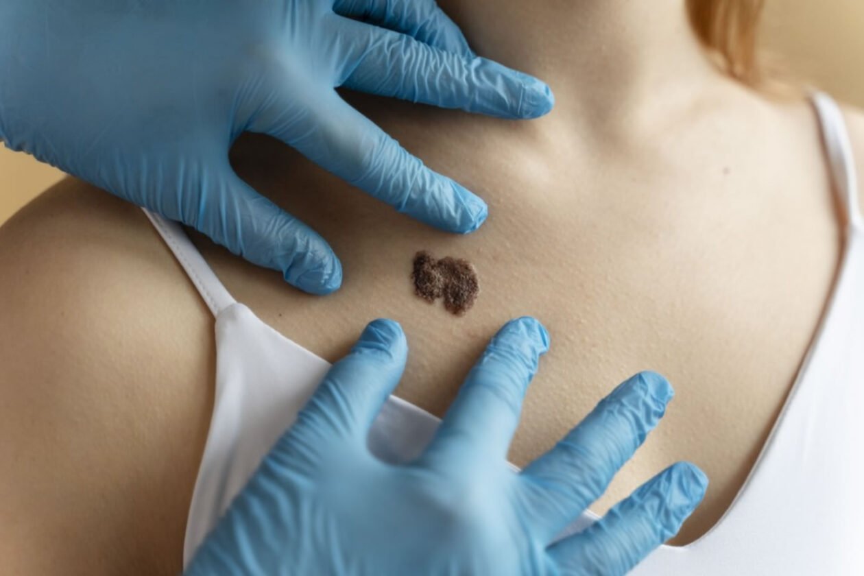 O sinal na pele que poucos notam: O que 5 casos recentes revelam sobre o melanoma